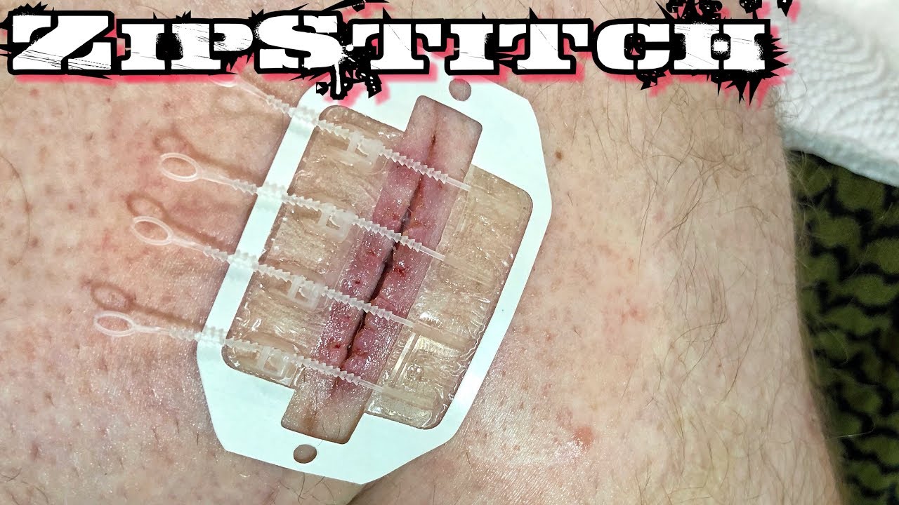 ZipStitch | World's Most Advanced Wound Closure Device!