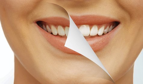 Pearly Whites: Is There Such A Thing As Too Much Bleaching?