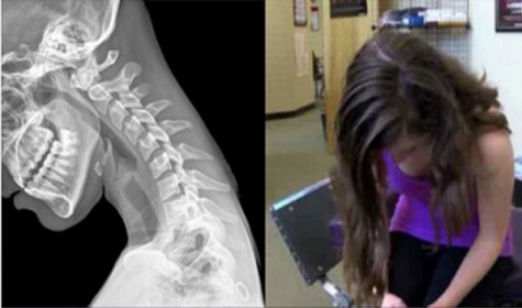 New Medical Phenomenon Affecting Smartphone Users But Especially Youth:  “Text Neck” Syndrome [VIDEO]