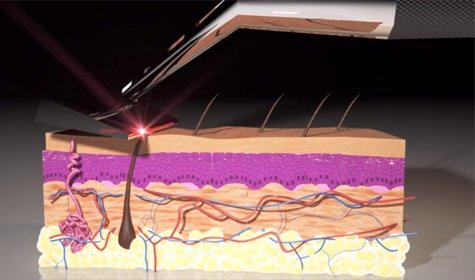 Could The Future of Shaving Be With A Laser? [VIDEO]
